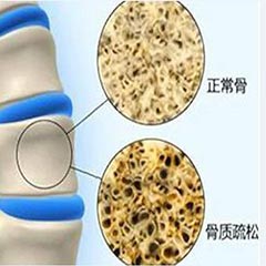 【骨密度分析儀科普】骨密度指標對照表，人手一份