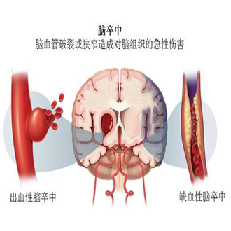 檢查腦卒中不要怕-經顱多普勒看透你的腦