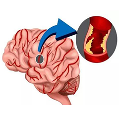 經顱多普勒廠家告訴你15個腦中風的誤區