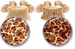 超聲骨密度儀品牌：骨質(zhì)變疏松的過(guò)程