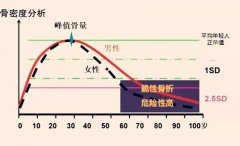 骨密度難防又難治 科學(xué)補(bǔ)鈣講究方法