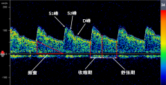 經顱多普勒檢查參數介紹