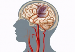 腦供血不足的4種表現 勸你早查腦血管